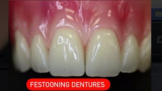 FESTOONING DENTURESنحت اللثة [upl. by Anirtek]