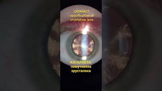 Катаракта  Cataract cataracta cataracte cataracttreatment cataract лечениекатаракты [upl. by Sim613]