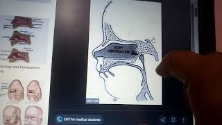 NASAL SYNIECHIA and CHOANAL ATRESIA with important points [upl. by Fauman]