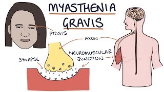 Myasthenia Gravis [upl. by Ydnerb]