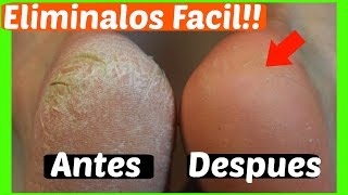 Elimina Los Hongos Y Los Callos En Los Pies Con ESTE Increíble Remedio Casero [upl. by Yma]