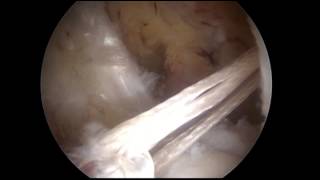 ACL Reconstruction with Single Bundle Hamstring Graft Graftlink [upl. by Tada611]