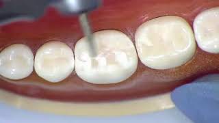 REST 528  All metal Crown  19  Occlusal Reduction [upl. by Nrek667]