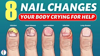 Nail signs of Disease  Nail pitting  Finger clubbing  Signs of anemia  Terrys nails [upl. by Hootman]