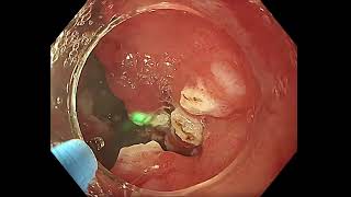 Thulium Fiber Laser for the treatment of GAVE syndrome [upl. by Franz]