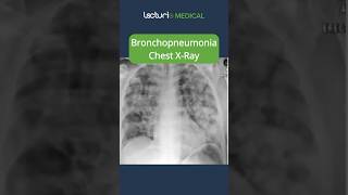 Understanding Bronchopneumonia 🫁 MedicalEducation usmle [upl. by Weisler]