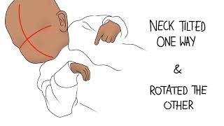 TORTICOLLIS  HEAL WRY NECK MORPHIC FIELD [upl. by Iggie]