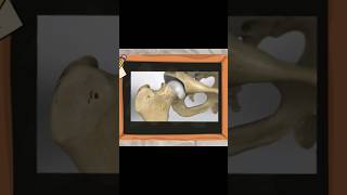 What is SCFE  scfe sufe ortholectures orthopaedics ortho orthodoc [upl. by Faythe]