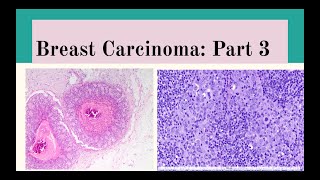 Breast Carcinoma Part 3 [upl. by Nailij355]