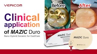 Clinical application of MAZIC DuroDr Bae [upl. by Dorrahs]