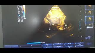 Subcostal view showing IVC with normal dimension and inspiratory collapse [upl. by Netsrek]