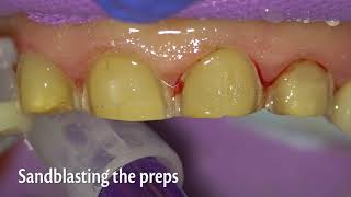 How effective is retraction paste for gingival retraction [upl. by Hennahane]