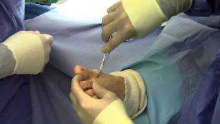 Dr Sherman Nagler  Bunionectomy  Akin Osteotomy [upl. by Ecinev]