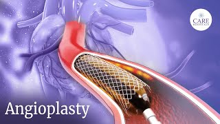 How is Angioplasty Done  Radial Access Procedure  PostTreatment Care After Angioplasty [upl. by Noramac766]