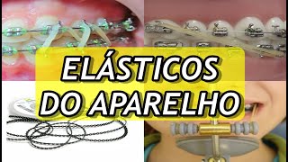 Tipos de ELÁSTICOS do Aparelho Ortodôntico  FUNÇÕES DE CADA UM DELES [upl. by Adne]