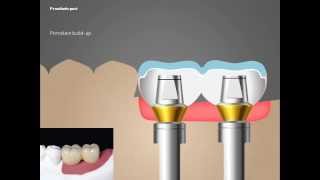 2D Manual Prosthetic part [upl. by Haisa]