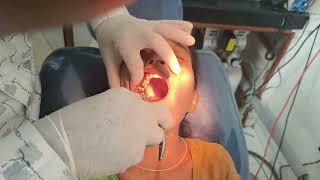 Painless removal of tooth but its too tough and patient is also strong [upl. by Bernice]