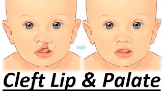 Causes of Cleft Lip amp Palate by Prof John Mew [upl. by Krusche410]