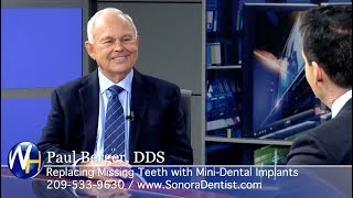 Replacing Missing Teeth with MiniDental Implants with Sonora CA dentist Dr Paul Berger [upl. by Idalia]