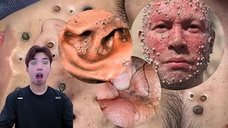 The MOST TERRIFYING Acne Squeezing Videos Youve Ever Seen 5 [upl. by Utham]