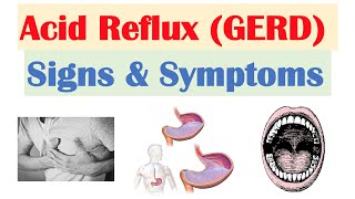 Gastroesophageal Reflux Disease GERD Signs amp Symptoms ex Bad Teeth  amp Why They Occur [upl. by Kristos]