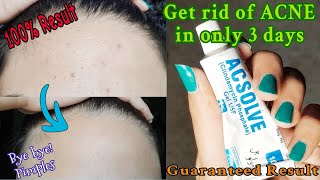 Remove AcnePimples Fast in 3 days Only  Acsolve Gel Review  Get rid of Breakouts Mahnoor I Shah [upl. by Ynnaf]