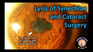 Lysis of Synechiae and Cataract Surgery  Tips amp Tricks [upl. by Nawud849]