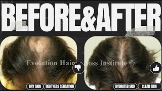 Bring back your hair in 30 days  How to treat hair fall  Scientific method  100  working [upl. by Oakleil]