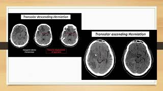 Brain herniation [upl. by Amling]