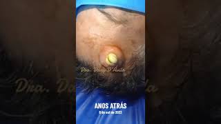 Botfly Maggot Removal spa doctor satisfying pimple removal [upl. by Uball]