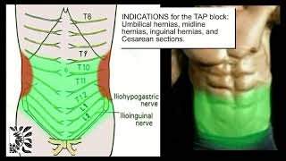 The UltrasoundGuided TAP Block [upl. by Nedearb307]