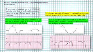 Retraso en la conducción intraauricular Clases EKG 15 [upl. by Sabra]