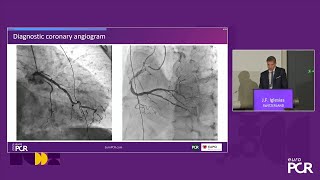 Revisiting thrombus aspiration in STEMI with continuous power aspiration system  EuroPCR [upl. by Claudianus434]