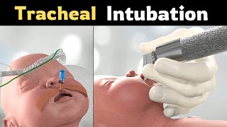 Tracheal Intubation Neonatal  Complete medical procedure [upl. by Nnylyram618]