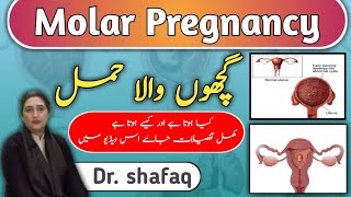 What is Molar Pregnancy guchoo wala hamal kia hai  dr 001Dr Shafaq snowform betahcg [upl. by Anabelle836]