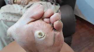 Warts Remove treatment part 2Treatment Continuefootcallous satisfying footcomfort footcare foot [upl. by Nivag276]