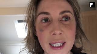 Blepharoplasty Video Diary  Day 10 After Surgery 8 of 15 [upl. by Casmey]