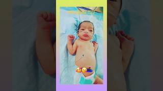 tracheoesophageal fistulanicu nicubaby viralvideo shorts 😍😍🥰🥰😘😘😘 [upl. by Noreik552]