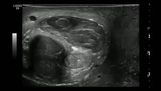 penile fracture  ultrasound case [upl. by Stu]