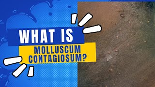 What is molluscum contagiosum [upl. by Ignatia]