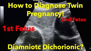 Twin Pregnancy  Diamniotic Dichorionic how to diagnose  easy steps [upl. by Dulci]