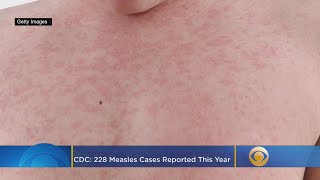 CDC monitoring nationwide rise in measles cases [upl. by Eineeuq]