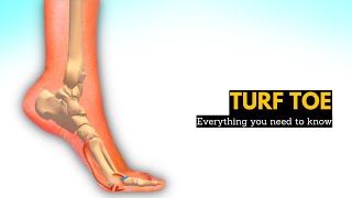 Dont Let Turf Toe Slow You Down How to Heal and Recover Fast [upl. by Sibell]