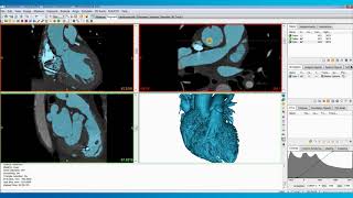 How to Create a Heart Model for 3D Printing  Mimics Innovation Suite  Materialise Medical [upl. by Adirehs]