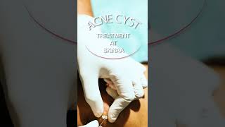 Effective Acne Cyst Treatment at Skinaa  Clear Skin Solutions by Top Dermatologists [upl. by Pennington]