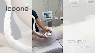 Icoone treatments at Renew Skin Clinic [upl. by Skcirdnek]