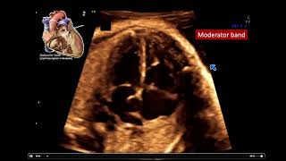 2022 Fetal Echocardiography Normal and Abnormal Hearts  A Video CME Teaching Activity [upl. by Guzel85]