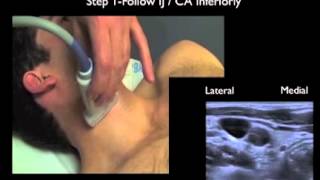 How to Supraclavicular Approach to Subclavian Vein Cannulation [upl. by Halsted738]