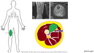 Soft Tissue Sarcoma [upl. by Edrea]