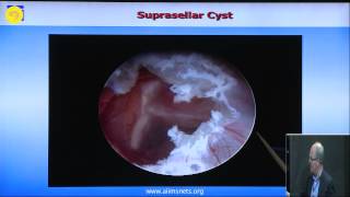 ETV and endoscopic intraventricular cyst management [upl. by Koa917]